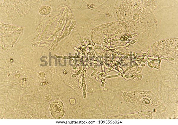 Pseudohyphae Budding Yeast Cells Patient Urine Stock Photo (Edit Now