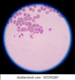 Pseudothrombocytopenia Platelet Clumping Possible Cause Low Stock Photo ...