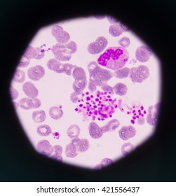 Pseudothrombocytopenia Platelet Clumping Possible Cause Low Foto de ...