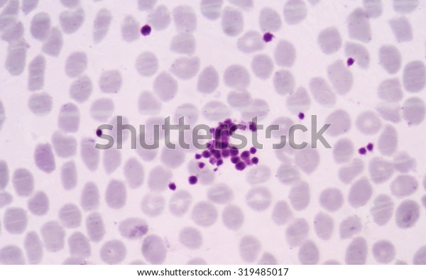 Pseudothrombocytopenia Platelet Clumping Possible Cause Low Stock Photo ...