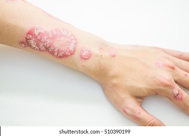 Psoriasis