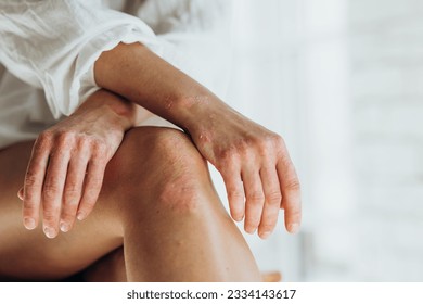 Psoriasis. Acute psoriasis on the knees, body, elbows is an autoimmune, incurable dermatological skin disease. Large, red, inflamed, scaly rash.