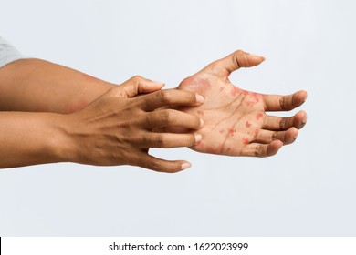 Psoriasis. Afro Woman Scratching Itch On Her Hand, Cropped, Grey Background