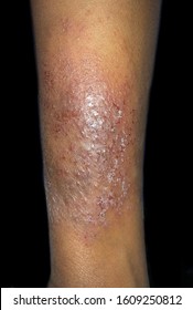 Psoriasis Or Atopic Dermatitis At Leg Of Southeast Asian, Myanmar Young Girl. It Is Condition Where Patches Of Skin Become Inflamed, Itchy, Red, Scaly, And Rough. Isolated On Black Background.