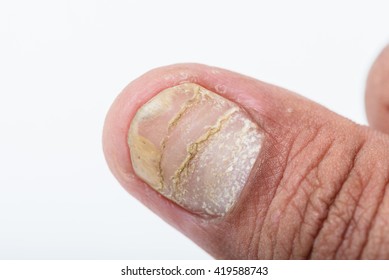 Psoriasis is an autoimmune disease that affects the nail, close up of Psoriasis nail isolated on white background.