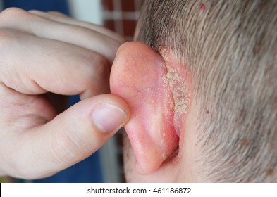 Removing psoriasis from ears - biodivmon.hu