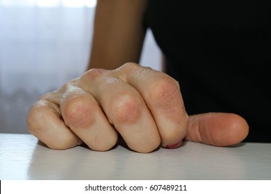 Psoriasis: close view of a hand affected by psoriasis on fingers and knuckles