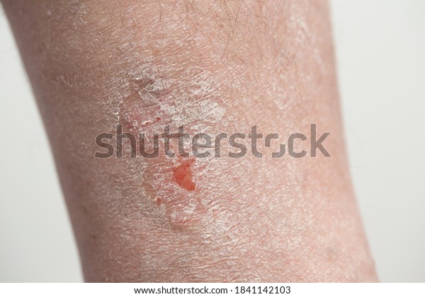 Psoriasis Closeup Area Lower Leg Patient Stock Photo Edit Now 1841142103