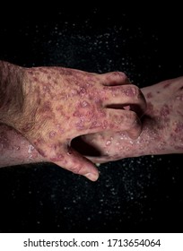 Psoriasis (eczema) On The Foot Man Itching Skin Psoriasis Scales Are Scattered On Black Background