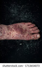 Psoriasis (eczema) On The Foot Man Itching Skin Psoriasis Scales Are Scattered On Black Background