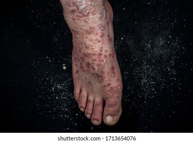 Psoriasis (eczema) On The Foot Man Itching Skin Psoriasis Scales Are Scattered On Black Background