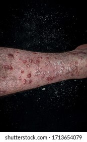 Psoriasis (eczema) On The Foot Man Itching Skin Psoriasis Scales Are Scattered On Black Background