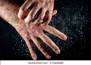 Psoriasis (eczema) On The Hand Man Itching Skin Psoriasis Scales Are Scattered On Black Background