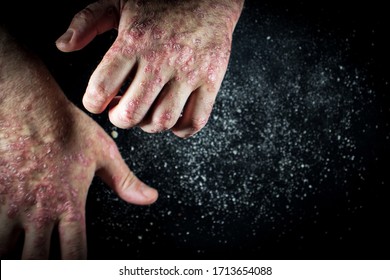 Psoriasis (eczema) On The Hand Man Itching Skin Psoriasis Scales Are Scattered On Black Background