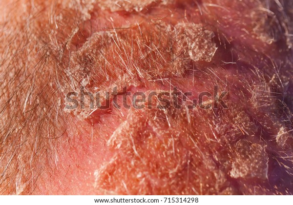 psoriasis eczema skin\
disease