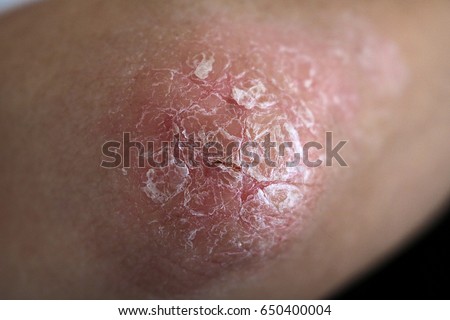 causes of dry flaky skin causes of dry flaky skin