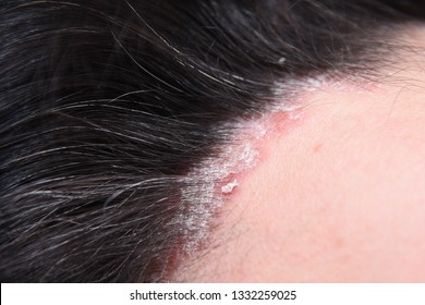 Psoriasis. Hairy Part Of The Head. Plasma Injection. Treatment Of Zabolivanie Plasma Human Blood.