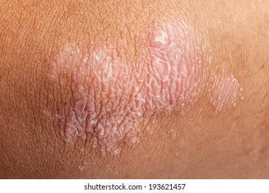 Psoriasis On Elbow Skin