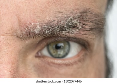 Psoriasis On The Eyebrow Close Up, Dermatological Diseases, Skin Problems.