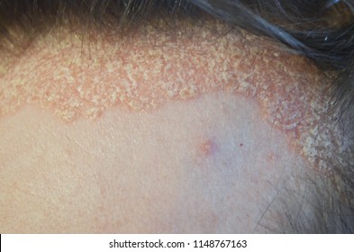 psoriasis on the hairline and on the scalp-close up, dermatological diseases - Shutterstock ID 1148767163