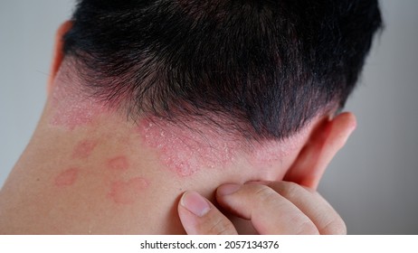 psoriasis on the nape of a man. skin with psoriasis.