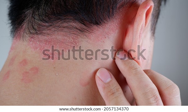 psoriasis on\
the nape of a man. skin with\
psoriasis.
