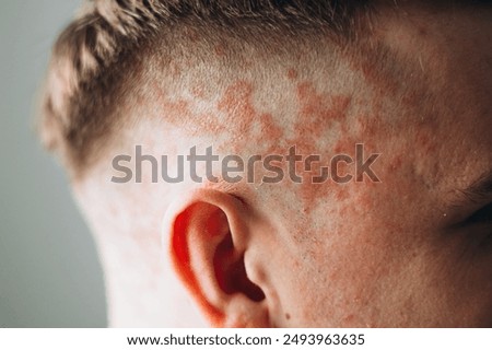 Similar – Image, Stock Photo Psoriasis skin with red wounds. Male arms with cracked, hard, horny, flaky skin. Dermatological problems of allergy, eczema. Hand stains, rash, dry skin. The concept of chronic disease treatment