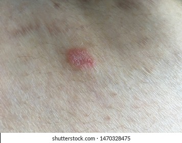 pinpoint red dots on skin nhs