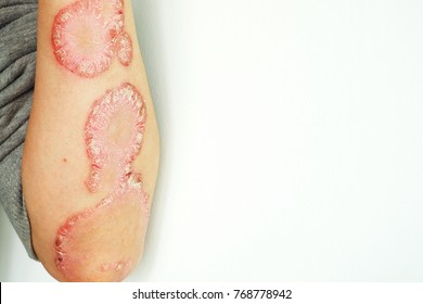 Psoriasis on white background