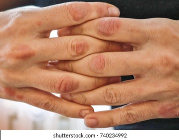 Psoriasis. Red dry patches on skin irritated by psoriasis or eczema. Psoriasis on hands.