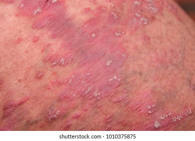 Psoriasis Skin Psoriasis Autoimmune Disease That Stock Photo 1010375875 ...