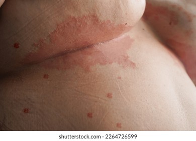 Piel de psoriasis. La psoriasis es una enfermedad autoinmune que afecta a la piel causa inflamación de la piel en rojo y escamoso.