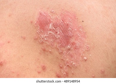 Psoriasis skin. Psoriasis is an autoimmune disease that affects the skin cause skin inflammation red and scaly.