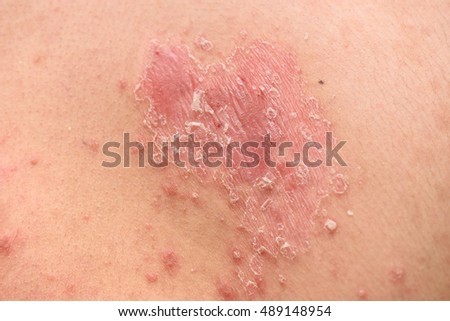 Psoriasis skin. Psoriasis is an autoimmune disease that affects the skin cause skin inflammation red and scaly.