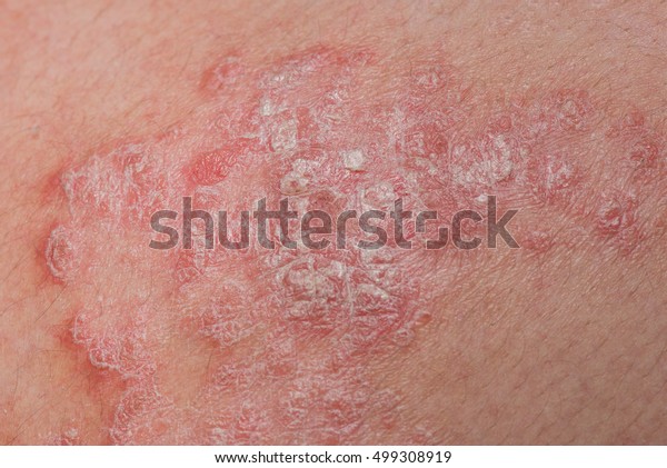 Psoriasis Skin Psoriasis Autoimmune Disease That Stock Photo Edit Now