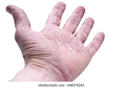 Psoriasis Skin Disease On Joints Body Stock Photo 648374242 | Shutterstock