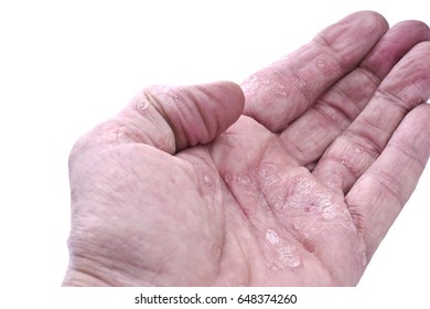 Psoriasis Skin Disease On Joints Body Stock Photo 648374260 | Shutterstock