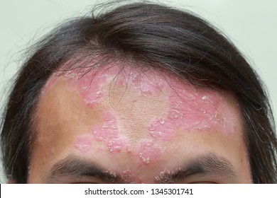 psoriasis face images)