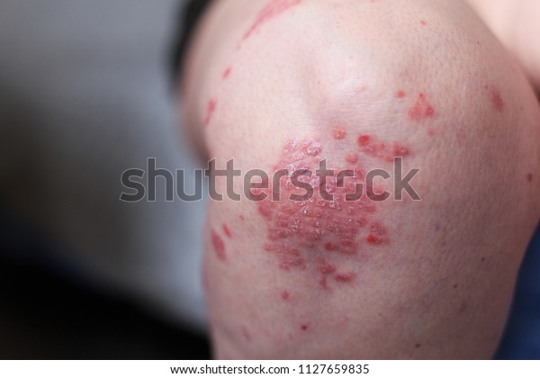 尋常性乾癬は 主に医学雑誌での細部撮影や皮膚に影響を及ぼす自己免疫疾患である アトピー性皮膚炎 湿疹は足の皮膚の炎症の一種である の写真素材 今すぐ編集