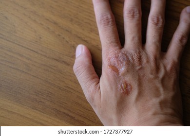 Psoriasis Vulgaris, Fungus, Eczema On Female Hand With Pus. Rash, Dermatological Problem On Dry Skin