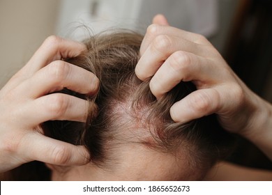 Psoriasis Vulgaris, Psoriatic Skin Disease In Head Hair, Skin Patches Are Typicaly Red, Itchy, And Scaly. Woman Furiously Scratching Her Head