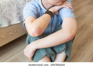 Psoriasis of a young girl on her elbows, sitting on the bedroom floor. Concept dermatology, skin diseases and care - Shutterstock ID 2047836242