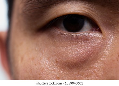 Ptosis (Droopy Eyelid) In Asian Male Oily Skin Type With Dark Eye Bag