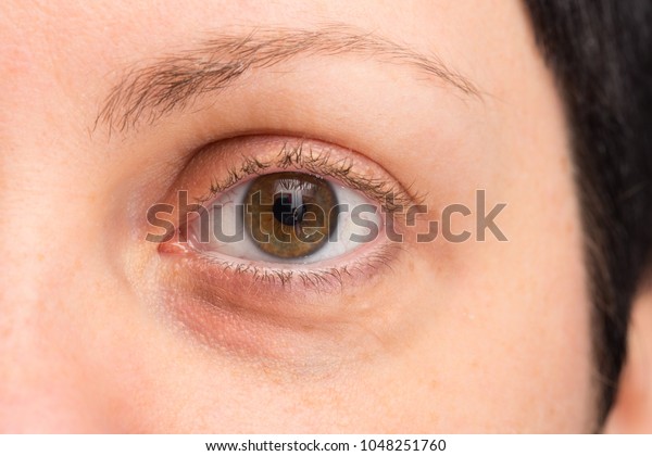 Puffy Eye Young Woman Before Cosmetic Stock Photo Edit Now 1048251760