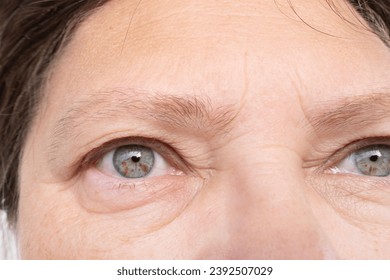 Puffy eyes of elderly Caucasian 55-year-old woman in close-up, swollen eyelids, medical issues and treatment options related to eye puffiness, health issues related to aging