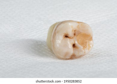 Pulled Out Wisdom Tooth Filling Caries Stock Photo (Edit Now) 1950283852