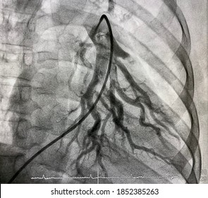 Pulmonary Angiography Of Left Lung Shown Pulmonary Embolism (PE).