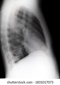 Pulmonary Aspergillosis In A 35 Year Old Female. Aspergillosis Is An Infection Caused By Mold. The Spores May Trigger An Allergic Reaction. Aspergillomas Or Fungus Balls Are Seen In Both Lungs