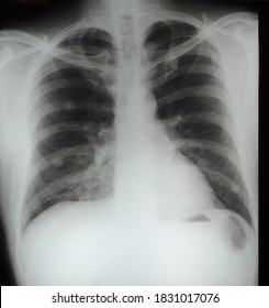 Pulmonary Aspergillosis In A 35 Year Old Female. Aspergillosis Is An Infection Caused By Mold. The Spores May Trigger An Allergic Reaction. Aspergillomas Or Fungus Balls Are Seen In Both Lungs