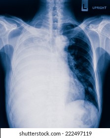 Pulmonary Edema